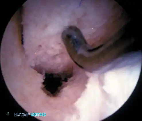 Fig. 48-44, cont’d G, Tibial tunnel should be posterior to roof of altered intercondylar notch to prevent graft impingement in knee extension. H, Use of 7-mm femoral offset guide to assist with femoral guidewire placement. I, Derotation slot at 12-o’clock position on femoral tunnel to allow guidewire placement and viewing of recessed graft and to prevent posterior migration of interference screw. J, Use of probe to guide graft into femoral tunnel, with cancellous portion of graft directly anterior. K, With knee ﬂ exed more than 100 degrees, guidewire is placed up femoral tunnel through middle cannula. Interference screw is passed, ensuring that guidewire and traction suture is a straight line and ensuring minimal divergence between screw and bone plug. L, Use of sheath to protect graft and to assist in placing screw parallel to graft.