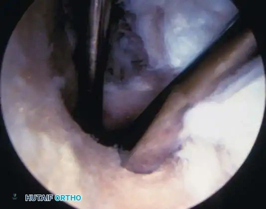 Fig. 48-44, cont’d G, Tibial tunnel should be posterior to roof of altered intercondylar notch to prevent graft impingement in knee extension. H, Use of 7-mm femoral offset guide to assist with femoral guidewire placement. I, Derotation slot at 12-o’clock position on femoral tunnel to allow guidewire placement and viewing of recessed graft and to prevent posterior migration of interference screw. J, Use of probe to guide graft into femoral tunnel, with cancellous portion of graft directly anterior. K, With knee ﬂ exed more than 100 degrees, guidewire is placed up femoral tunnel through middle cannula. Interference screw is passed, ensuring that guidewire and traction suture is a straight line and ensuring minimal divergence between screw and bone plug. L, Use of sheath to protect graft and to assist in placing screw parallel to graft.