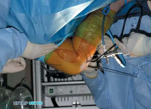 Arthroscopy of the Lower Extremity Surgical Diagram