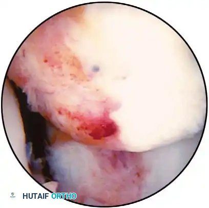 Fig. 48-45 A, Calciﬁ ed stump of anterior cruciate ligament after chronic tear. B, Empty lateral wall sign indicating anterior cruciate ligament–deﬁ cient knee; anterior cruciate ligament can be attached to posterior cruciate ligament, giving false indication of functional ligament.