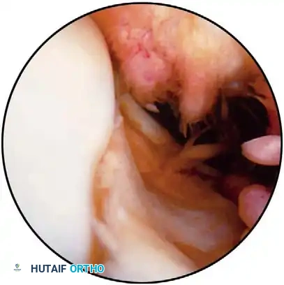 Fig. 48-45 A, Calciﬁ ed stump of anterior cruciate ligament after chronic tear. B, Empty lateral wall sign indicating anterior cruciate ligament–deﬁ cient knee; anterior cruciate ligament can be attached to posterior cruciate ligament, giving false indication of functional ligament.