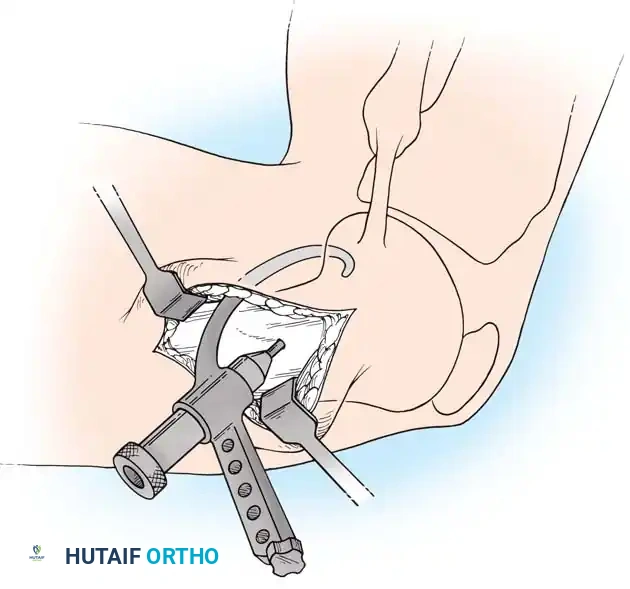 Arthroscopy of the Lower Extremity Surgical Diagram