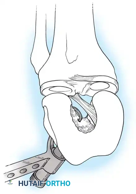 Arthroscopy of the Lower Extremity Surgical Diagram