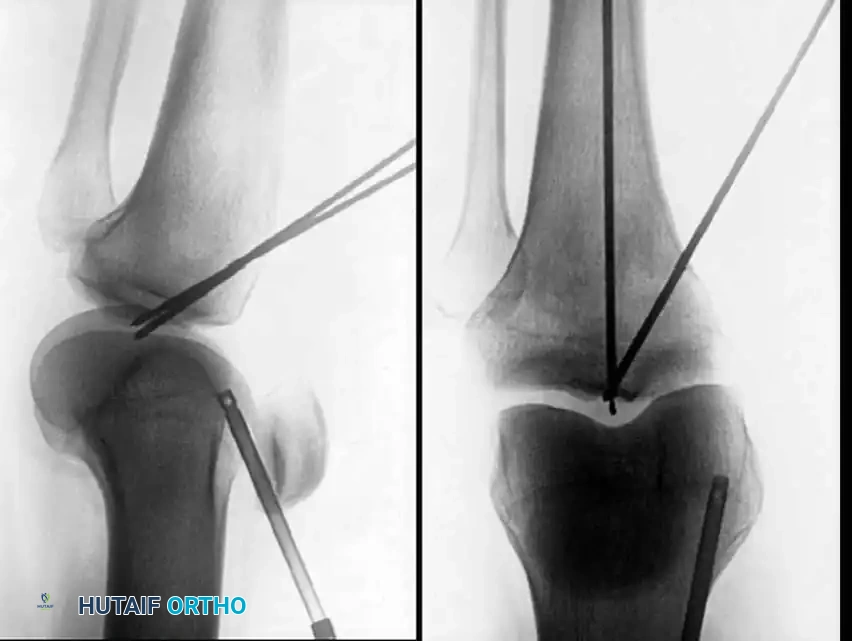 Arthroscopy of the Lower Extremity Surgical Diagram