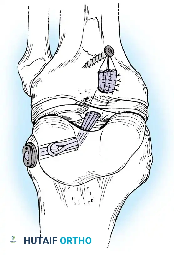 Arthroscopy of the Lower Extremity Surgical Diagram