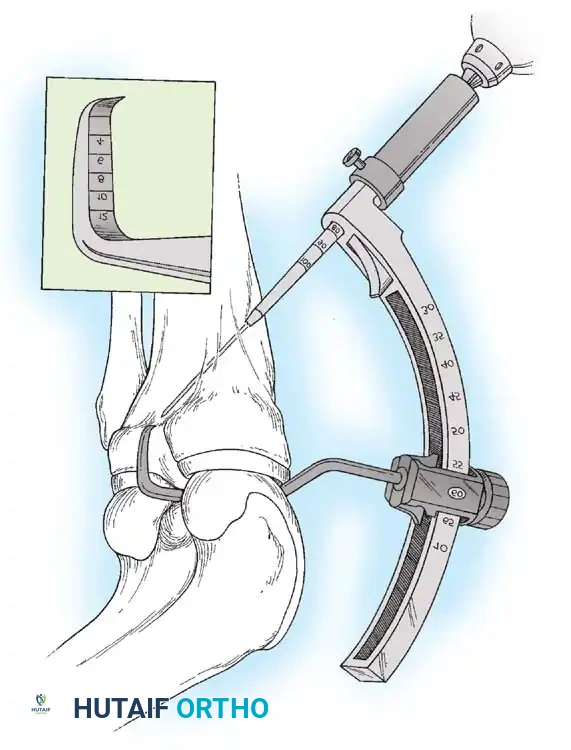 Arthroscopy of the Lower Extremity Surgical Diagram