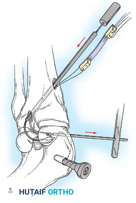 Arthroscopy of the Lower Extremity Surgical Diagram