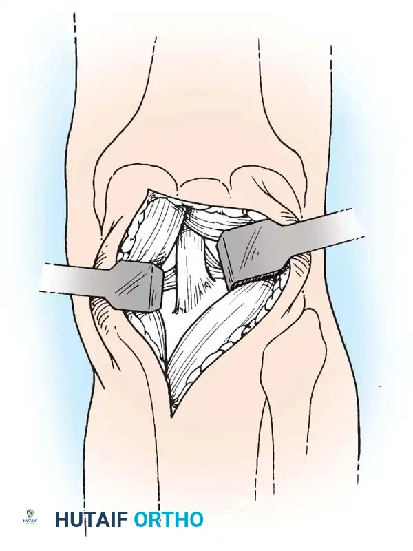 Semimembranosus muscle