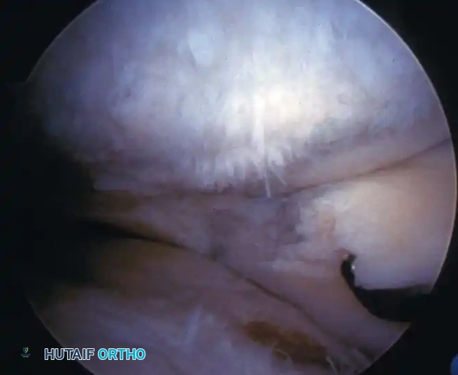 Fig. 48-55 Degenerative medial compartment with grade III chondromalacia of femoral condyle, degenerative meniscal tear, and small area of grade IV chondromalacia of tibial articular surface just below probe.