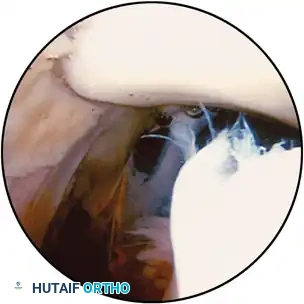 Fig. 48-58 Patellofemoral joint view from superolateral portal; lateral subluxation of patella is evident.