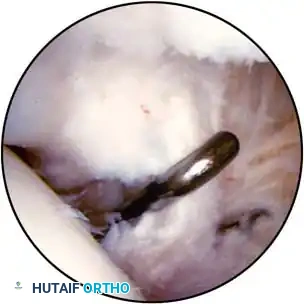 Fig. 48-61 A, Localized nodular synovitis of posteromedial compartment of knee. B, Arthroscopic excision of localized nodular synovitis with arthroscope in posteromedial portal and probe through intercondylar notch to palpate posterior cruciate ligament. Synovial attachment of nodular synovitis is just superior and posterior to probe.