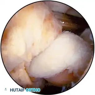 Fig. 48-61 A, Localized nodular synovitis of posteromedial compartment of knee. B, Arthroscopic excision of localized nodular synovitis with arthroscope in posteromedial portal and probe through intercondylar notch to palpate posterior cruciate ligament. Synovial attachment of nodular synovitis is just superior and posterior to probe.