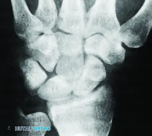 FIGURE 69-12 A, Posteroanterior view of capitate shows no definite abnormality.