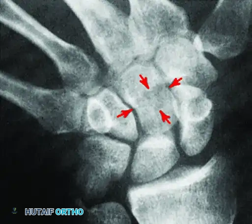 FIGURE 69-12 B, On angled view, cystic defect with fracture is seen in capitate waist (arrows).