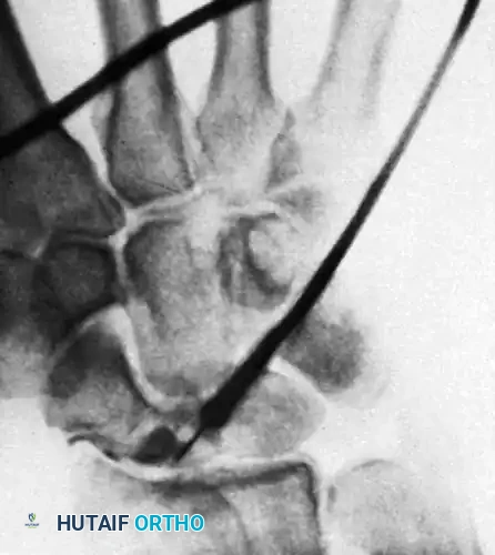 FIGURE 69-13 A, Needle in place, start of contrast injection.