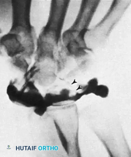 FIGURE 69-13 C, With ulnar deviation, contrast material passes into midcarpal joint between lunate and triquetrum (arrowheads), indicating lunotriquetral ligament tear.