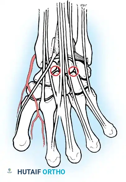 Midcarpal ulnar portal Midcarpal radial portal