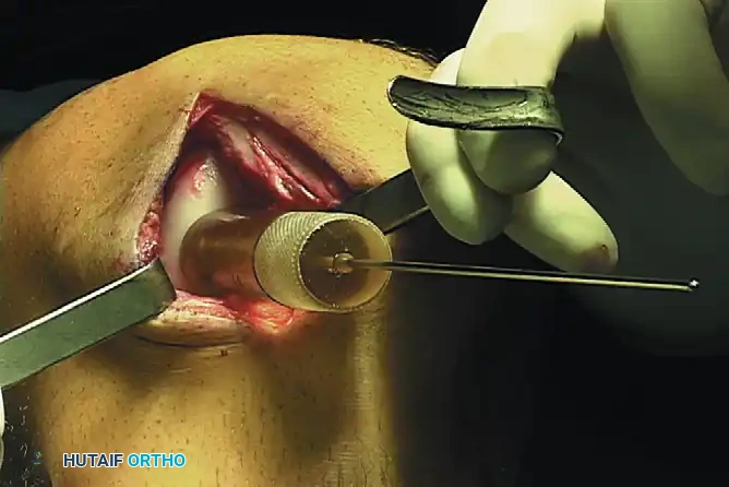 ARTICULAR CARTILAGE INJURIES Surgical Diagram