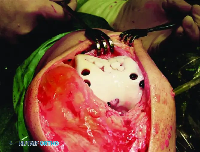 ARTICULAR CARTILAGE INJURIES Surgical Diagram