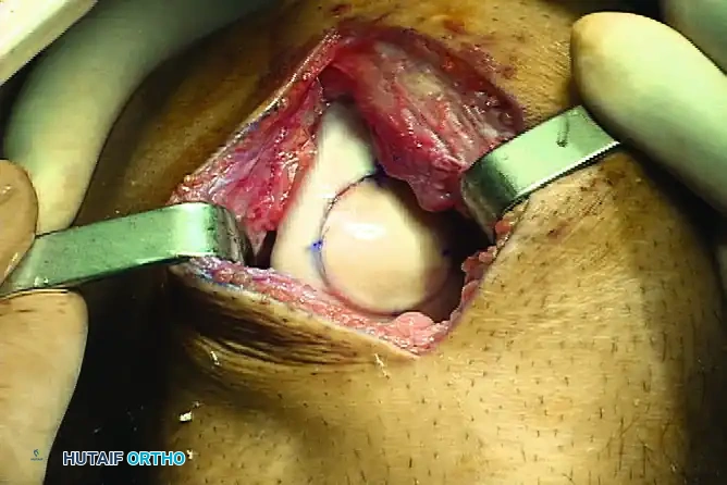 ARTICULAR CARTILAGE INJURIES Surgical Diagram