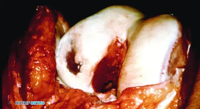 ARTICULAR CARTILAGE INJURIES Surgical Diagram