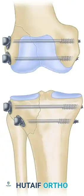 Masterclass in ASIF Cancellous Screw and Plate Fixation Techniques