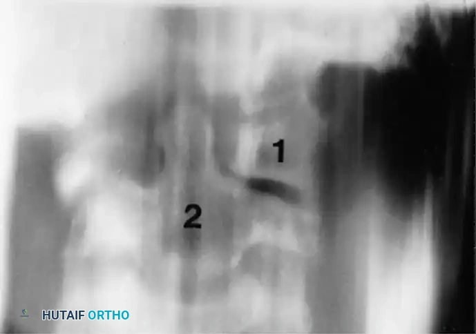 ATLANTOAXIAL ROTATORY SUBLUXATION Surgical Diagram