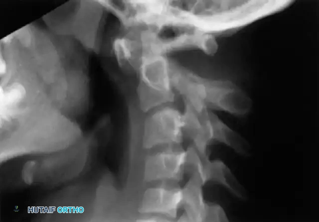 Atlantooccipital Fusion: Comprehensive Surgical Guide