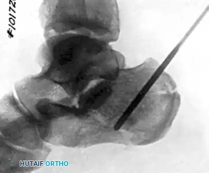 AXIAL FIXATION OF CALCANEAL FRACTURE Surgical Diagram