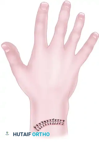 Skin closed by insufficient number of sutures placed too superficially