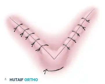 Apical stitch diagram 2