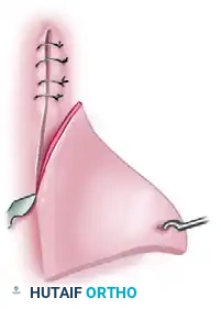 Dog ear excision step C