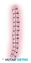 Dog ear excision step D