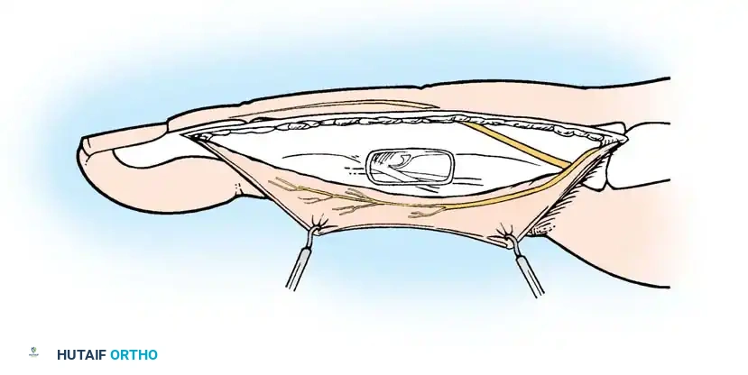 Fig. 61-16 Midlateral approach especially to expose ﬂ exor tendon sheath.