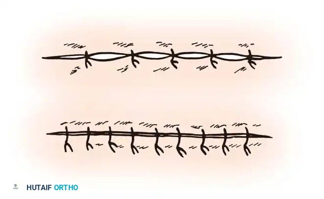BASIC SKIN TECHNIQUE Surgical Diagram