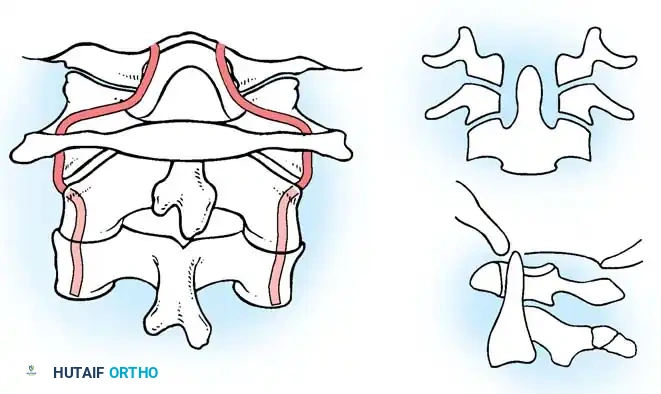 Basilar Impression: Comprehensive Surgical Management and Craniocervical Biomechanics