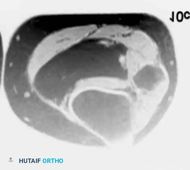 BENIGN TUMORS AND TUMOR-LIKE LESIONS Surgical Diagram
