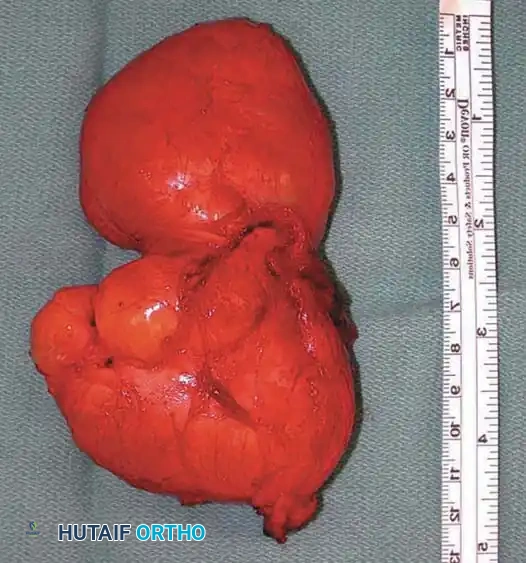 BENIGN TUMORS AND TUMOR-LIKE LESIONS Surgical Diagram
