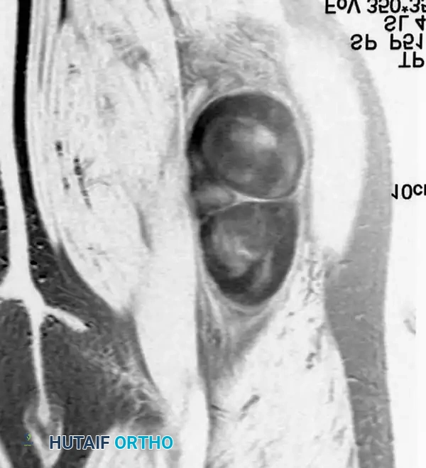BENIGN TUMORS AND TUMOR-LIKE LESIONS Surgical Diagram