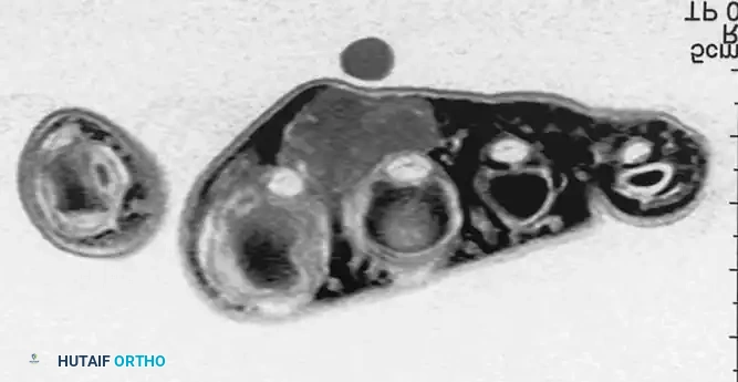BENIGN TUMORS AND TUMOR-LIKE LESIONS Surgical Diagram