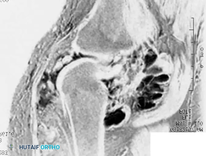 BENIGN TUMORS AND TUMOR-LIKE LESIONS Surgical Diagram
