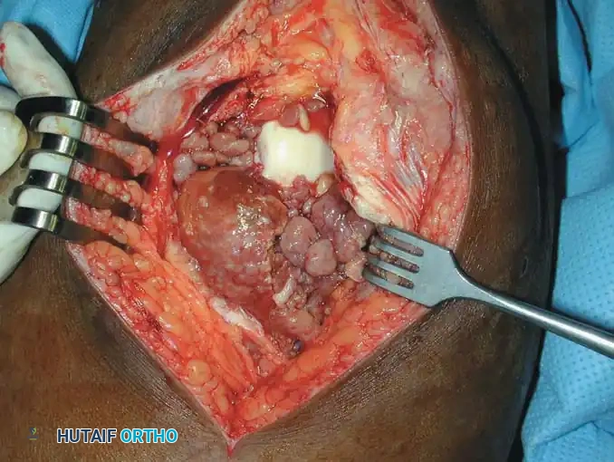 BENIGN TUMORS AND TUMOR-LIKE LESIONS Surgical Diagram