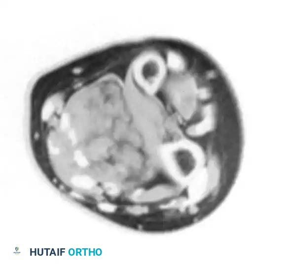 BENIGN TUMORS AND TUMOR-LIKE LESIONS Surgical Diagram