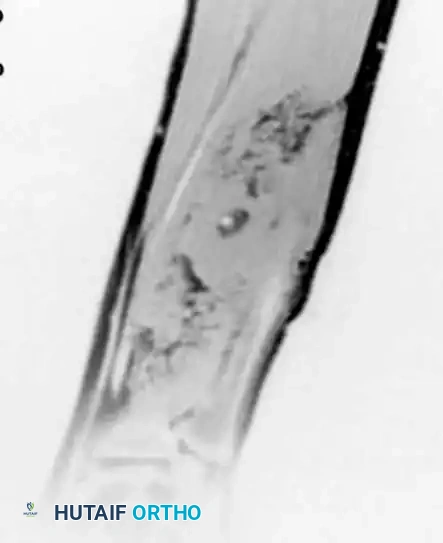 BENIGN TUMORS AND TUMOR-LIKE LESIONS Surgical Diagram