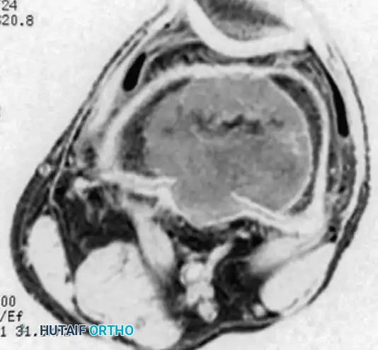 Benign/Aggressive Tumors of Bone Surgical Diagram