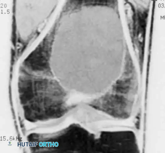Benign/Aggressive Tumors of Bone Surgical Diagram