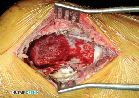 Benign/Aggressive Tumors of Bone Surgical Diagram
