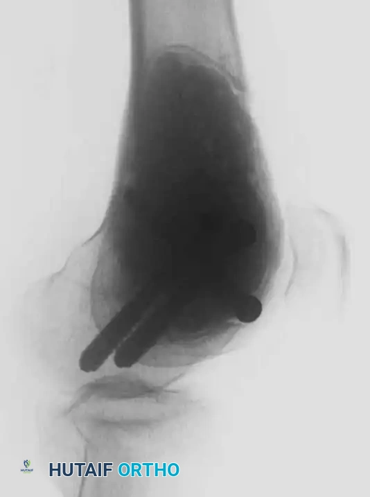 Benign/Aggressive Tumors of Bone Surgical Diagram