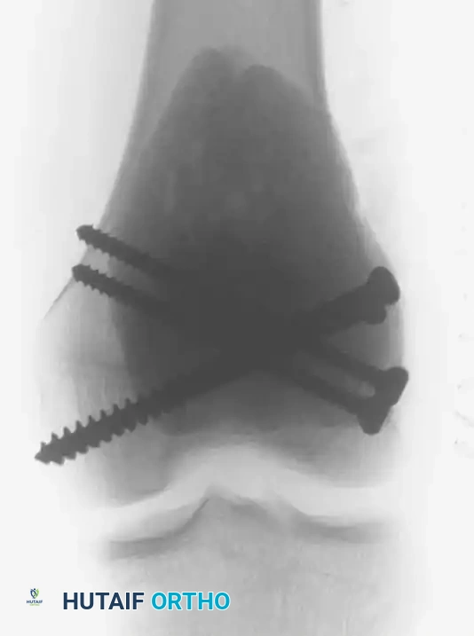 Benign/Aggressive Tumors of Bone Surgical Diagram