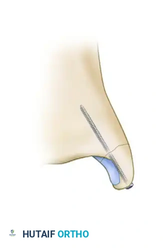 BIMALLEOLAR FRACTURE Surgical Diagram